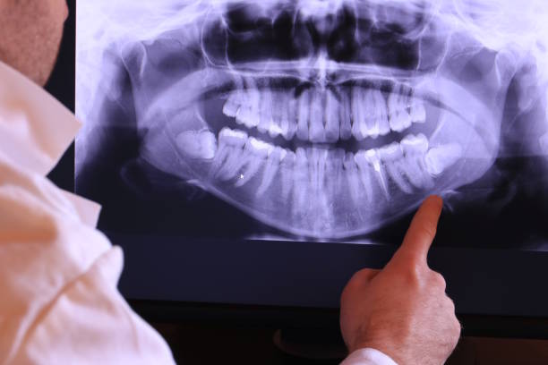 Best Emergency Wisdom Tooth Extraction in Buchanan, VA