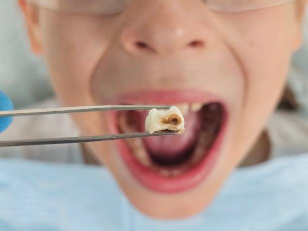 Best Emergency Treatment for Oral Infections in Buchanan, VA